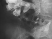 English: KUB Radiograph showing a large staghorn calculus involving the major calyces and renal pelvis in a person with severe scoliosis. Struvite stones can grow rapidly, forming large calyceal staghorn calculi which can require invasive surgery such as 