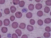English: Giant Platelets on a blood smear (40x). Español: Plaquetas en un frotis sanguíneo (40x).