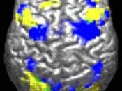 Autistic individuals tend to use different areas of the brain (yellow) for a movement task compared to a control group (blue). Powell K. Opening a window to the autistic brain. PLoS Biol . 2004 ;2(8) :E267. doi:10.1371/journal.pbio.0020267. PMID 15314667.