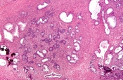 English: Micrograph of nodular hyperplasia of the prostate, also known as benign prostatic hyperplasia (BPH) and benign prostatic hypertrophy. H&E stain. Prostate currettings from a TURP.