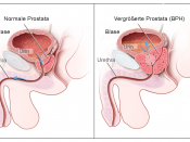 English: Two-panel drawing shows normal male reproductive and urinary anatomy and benign prostatic hyperplasia (BPH). Panel on the left shows the normal prostate and flow of urine from the bladder through the urethra. Panel on the right shows an enlarged 