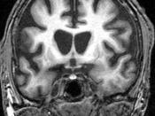 English: Coronal FSPGR through the brain at the level of the caudate nuclei demonstrating marked reduced volume in keeping with the patient's known diagnosis of Huntington Disease. Image from Radiopaedia.org case here