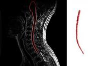 English: Cervical spine MRI with enhancement showing multiple sclerosis