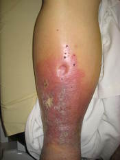 English: Pitting edema of the lower leg in a patient with end stage hepatic failure.