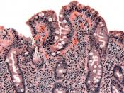 Biopsy of small bowel showing coeliac disease manifested by blunting of villi, crypt hyperplasia, and lymphocyte infiltration of crypts, consistent with Marsh classification III. Released into public domain on permission of patient. -- Samir धर्म 11:23, 1