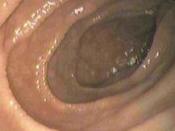 Endoscopic still of duodenum of patient with celiac disease showing scalloping of folds.