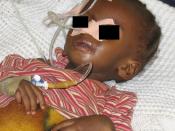 A severely malnourished child with a nasogastric feeding tube and IV. Nigeria (Please cover the child's eyes - Patient confidentiality)