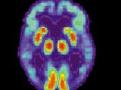 English: PET scan of a human brain with Alzheimer's disease