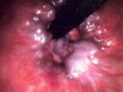 English: Endoscopic image of hemorrhoids seen on retroflexion of the flexible sigmoidoscope at the ano-rectal junction. Released into public domain on permission of patient. Please keep disclaimer on.