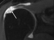 English: MRI of rotator cuff full-thickness tear