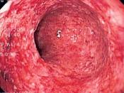 Endoscopic image of severe Crohn's colitis showing diffuse loss of mucosal architecture, friability of mucosa in sigmoid colon and exudate on wall. Photo released into public domain on permission of patient. -- Samir धर्म 07:37, 2 June 2006 (UTC) Category