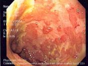 Endoscopic image of ulcerative colitis affecting the left side of the colon. The image shows confluent superficial ulceration and loss of mucosal architecture. Crohn's disease may be similar in appearance, a fact that can make diagnosing UC a challenge.
