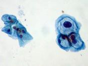 HPV/LSIL On Pap Smear ThinPrep liquid-based Pap. Normal squamous cells on left; HPV-infected cells with mild dysplasia (LSIL) on right. See also File:Low-Grade SIL with HPV Effect.jpg - Another example of LSIL with HPV changes. File:High-Grade SIL.jpg - H