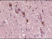 English: Lewy Bodies in Locus coeruleus as seen in Parkinson's disease