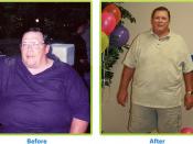 Before and after weight loss surgery