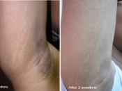 English: Stretch marks before and after 2 procedures