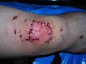 English: Stiches on the human knee, 3 days post surgery (which did a nurse instead of a M.D.). Note the infection in the center of the knee.