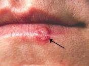Nederlands: Public Health Image Library http://phil.cdc.gov/Phil/default.asp PHIL ID# 1573 Title: Herpes simplex lesion of lower lip, second day after onset. Content Provider(s): CDC/Dr. Herrmann Creation Date: (1964) Description: Herpes simplex lesion of