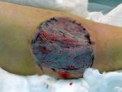 English: Skin graft on leg trauma, some 5 days after surgery. Take and healing aided by VAC.