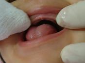 English: Oral hygiene of an edentulous baby's mouth using gauze and hydrogen peroxide
