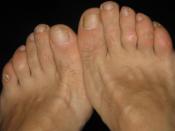 English: Painful corns at both feet of a 51-year-old woman with severe tranverse flat feet. Mycosis has affected some nails, and she also suffers from a very painful thick plantar wart at her right foot. Marionette Deutsch: Schmerzhafte Hühneraugen an den