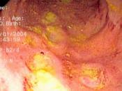 Endoscopic image of Crohn's colitis showing deep ulceration in sigmoid colon.