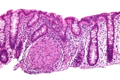 English: Esophagus - intermed mag. Image:Crohn's disease - esophagus - intermed mag.jpg