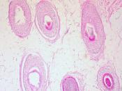 Mature Cystic Teratoma of the Ovary: Hair Follicles