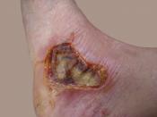 English: Eight day old fourth degree burn on arch of foot caused by motorcycle muffler.