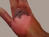 Second-degree burn caused by contact with boiling water