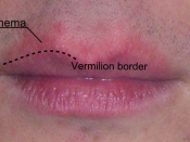 English: Erythema above the lips, appeared concomitantly with chapped lips due to exposure to very cold temperature.