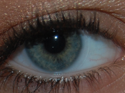 English: Eye with a contact lens (myopia).