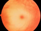 English: Cherry red spot as seen in Tay Sachs disease. The center of the fovea appears bright red because it is surrounded by a milky halo.