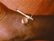 Guinea worm (Dracunculus)
