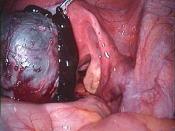 perforated endometriosis cyst of the left ovary