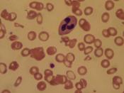 Blood smear of a patient with Iron deficiency anemia at 40x enhancement Español: Frote de anemia por deficiencia de hierro. (Microscopio de luz 40x)