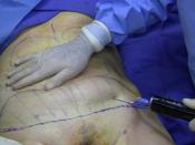 English: A 40-year old woman undergoing a combination liposuction and abdominoplasty. Power-assisted liposuction is the technique being performed in this image. The cannula is inserted to about 80% of its full length.