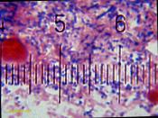 English: Microscopic view of dental plaque, showing Gram-positive and Gram-negative bacteria. 100× objective, 15× eyepiece. Numbered ticks are 11 µM apart. Gram-stained. Each pixel on the full-sized version of this image represents a 0.0