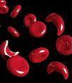 English: Sickle cells characterize sickle cell anemia, an autosomal recessive genetic disorder.