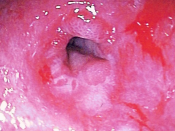 Endoscopic image of peptic stricture showing narrowing of the esophagus near the junction with the stomach due to chronic gastroesophageal reflux in the setting of scleroderma.