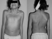 English: A 12-year-old female with Noonan syndrome. Typical webbed neck. Double structural curve with rib deformity.