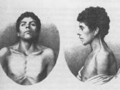English: The oldest known case of Noonan syndrome, described in 1883 by Kobylinski