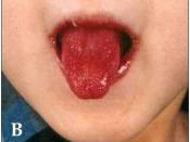 English: Kawasaki disease: Strawberry tongue and bright red, swollen lips with vertical cracking and bleeding.
