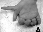 English: Preaxial polydactyly of the right hand.