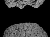 Healthy brain (bottom) versus brain of a donor with Alzheimer's disease. Notable is the 