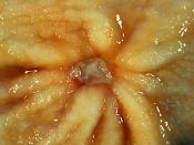 A benign gastric ulcer (from the antrum) of a gastrectomy specimen.