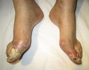 English: Severe gout complicated by tophi (exudate is uric acid crystals)
