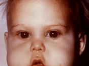 This 1970 photograph depicts an infant presented with symptoms indicative of en:Kwashiorkor, a dietary protein deficiency, as well as a Vitamin B deficiency. Kwashiorkor sufferers, i.e., inadequate dietary protein intake, show signs of thinning hair or “F