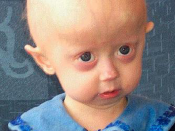 Hutchinson-Gilford Progeria Syndrome. HGPS is a childhood disorder caused by mutations in one of the major architectural proteins of the cell nucleus.