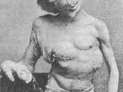 English: A photograph of Joseph Merrick (1862–1890), sometimes called the 